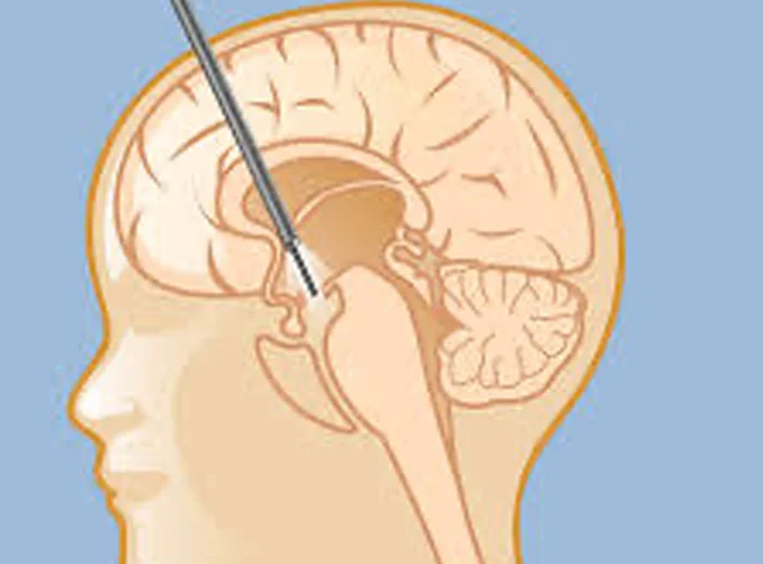 Endoscopic Brain Surgeries